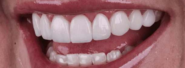 Sorriso de perto, dentes claros e alinhados